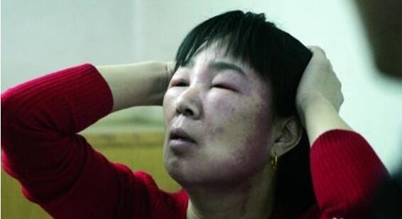 芒果过敏第几天最严重,芒果过敏几天能自愈呢